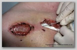 wound image